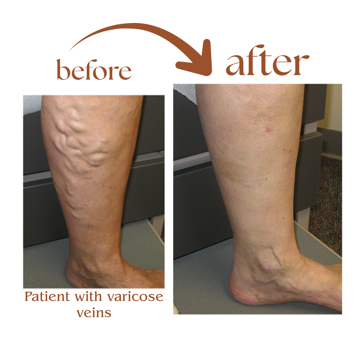 Varicose Veins Spray
